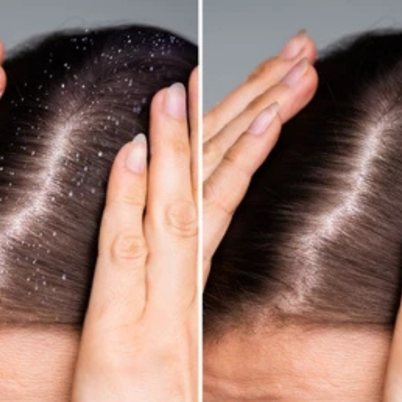 Anti-Dandruff Actives